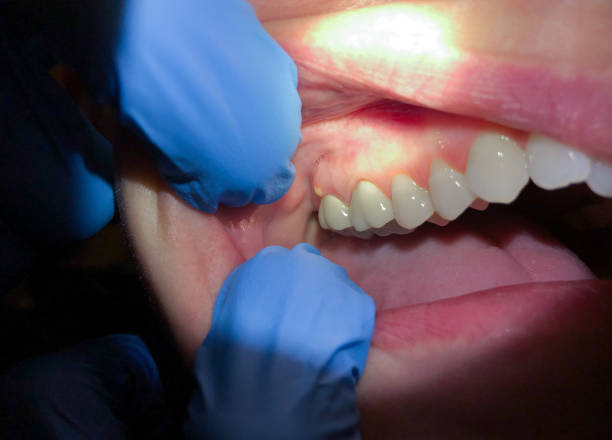 Best Emergency Root Canal Treatment in Rexburg, ID